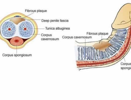 Benefits of Penile Traction for Peyronie’s Disease